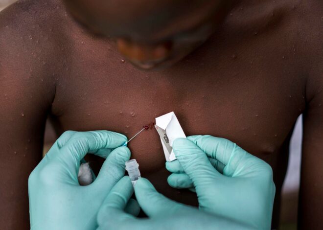 Emergencia global: cómo se contagia la viruela del mono, los síntomas y los casos en la Argentina