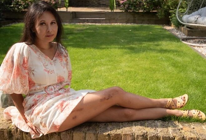 “Me operé para alargar mis piernas y todo salió terriblemente mal” “Me operé para alargar mis piernas y todo salió terriblemente mal”