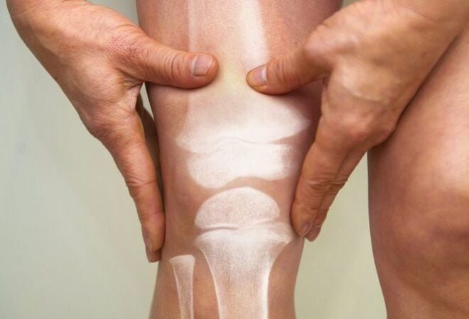 Los 6 antiinflamatorios naturales que se pueden usar para terminar con el dolor de rodilla Los 6 antiinflamatorios naturales que se pueden usar para terminar con el dolor de rodilla
