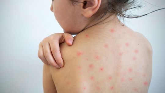 Hay alerta por cuatro brotes de sarampión y un llamado urgente para que la población se vacune