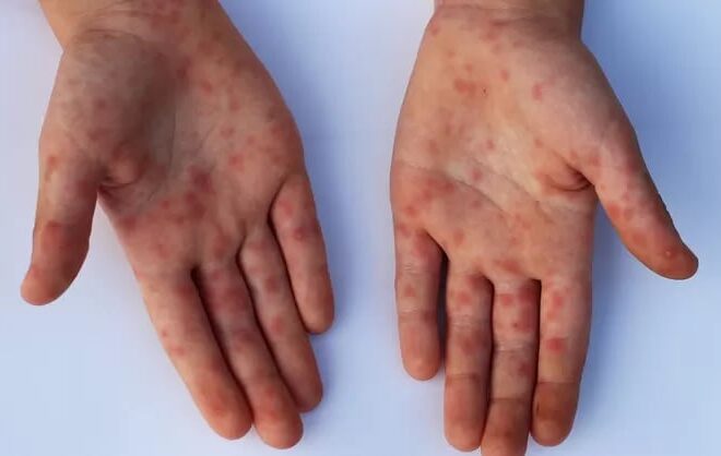 Viruela del mono en la Argentina: cuáles son los síntomas de la variante Mpox Clado Ib Viruela del mono en la Argentina: cuáles son los síntomas de la variante Mpox Clado Ib